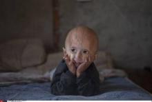  Un enfant atteint de progeria.